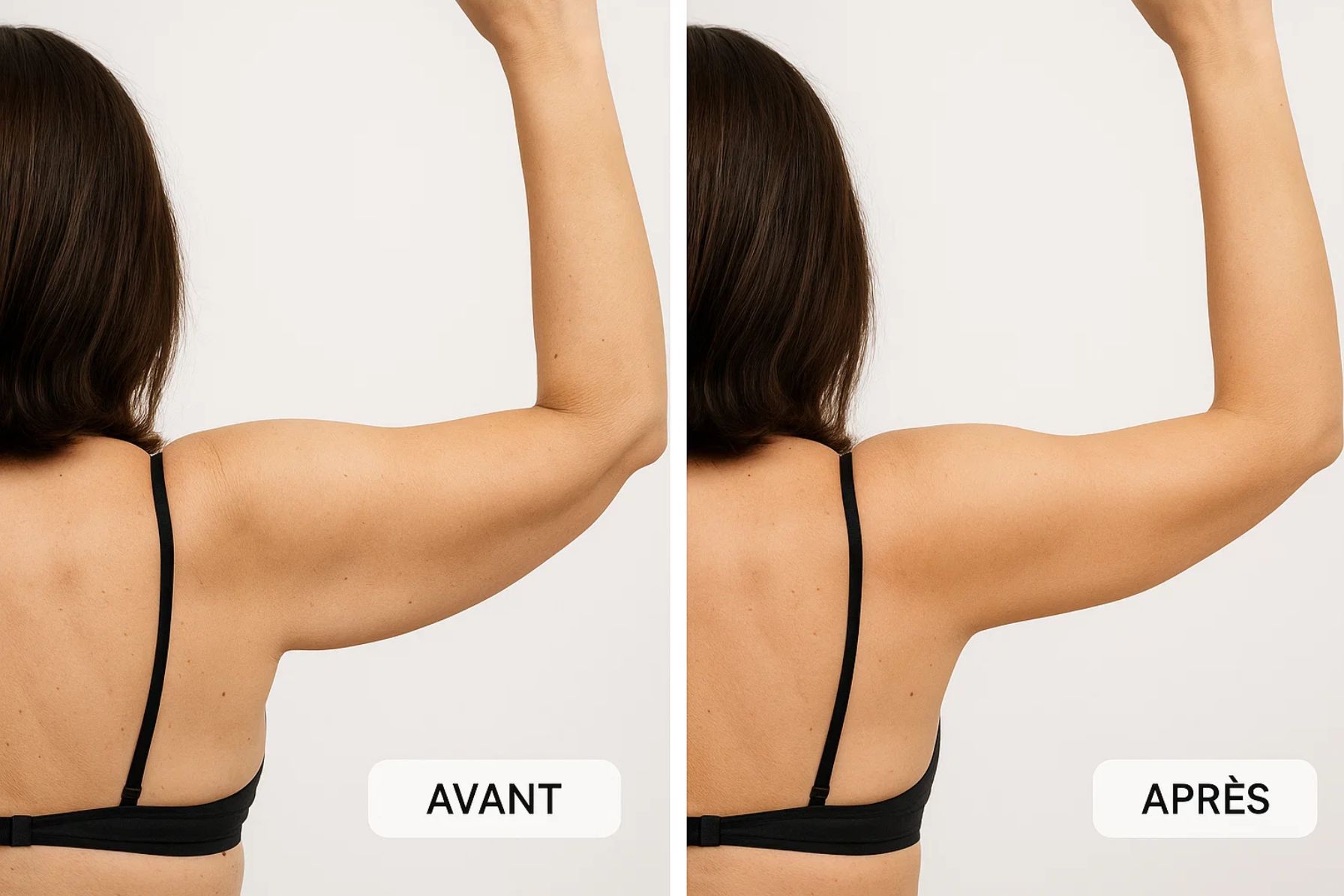 Cryolipolyse bras